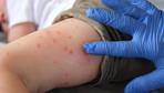 OHAL İLAN EDİLDİ ABDde 1991den bu yana en ağır salgın