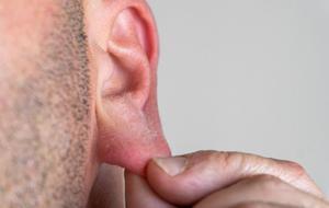 Kulak Memesinde Beze Neden Olur, Nasıl Geçer? Kulak Memesinde Beze İçin Hangi Doktora Gidilir?