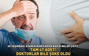 TAM 47 ADET! Doktorlar bile şoke oldu! 60 yaşındaki adamın midesinden bakın neler çıktı!