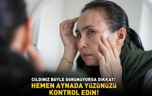 Hemen aynada yüzüne bakın! Eğer cildiniz böyle görünüyorsa dikkat! Sağlıksız bağırsakların 6 uyarı işareti!