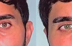 Yeşil mi, Mavi mi? Göz Rengini Kalıcı Olarak Değiştirmek Mümkün! İşte En Çok Talep Edilen Renk... Göz Rengi Nasıl Değiştiriliyor? Göz Rengi Değiştirmenin Riski Var mı?
