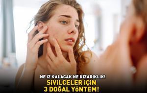 SİVİLCELER İÇİN 3 DOĞAL YÖNTEM! Ne iz kalacak ne de kızarıklık! '10-15 dakika bekletmek yetiyor!'