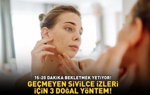 GEÇMEYEN SİVİLCE İZLERİ İÇİN 3 DOĞAL YÖNTEM! Cildi bebek gibi yapıyor! 15-20 dakika bekletmek yetiyor!
