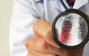 Sessiz Tehdit Zatürre! Kimler Risk Altında? İşte En Etkili Korunma Yolu