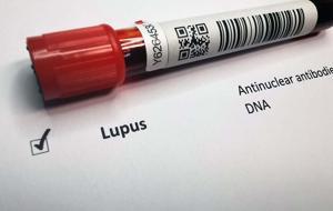 Kadınlarda 9 Kat Daha Fazla Görülüyor! En Önemli Tetikleyicileri Gün Işığı ve Dışarıdaki Alerjenler... İşte O Hastalık