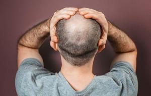 Kelliğe Çare Bulundu! Dünyanın Konuştuğu İlaç: Saçları Yüzde 539 Çoğalttı