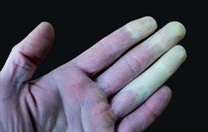 El ve Ayaklarda Aniden Oluşan Mavi-Mor Renk Değişimleri Bu Hastalığın Habercisi! En Sık Bu Kişilerde Görülüyor