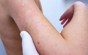 Çocuklarda Egzama: Nedenleri, Belirtileri ve Etkili Çözümler