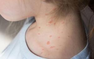 Suçiçeği Alarmı: Uzmanlar Aileleri Uyarıyor!