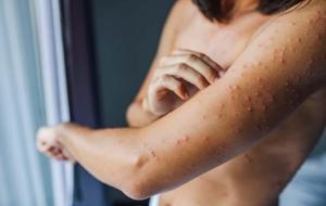 50 Yaş Üstüne Uyarı: Çocuklukta Uyuyan Virüs, Yıllar Sonra Sessizce Uyanıyor! Yanma, Batma ve İzler… Zona’nın Gizemli Yolculuğu