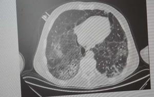 Dünyada 4’üncü Ölüm Nedeni! Akciğerleri Tahrip Eden 2 Hastalık: KOAH ve Zatürre...Uzmanı En Etkili Korunma Yöntemini Açıkladı