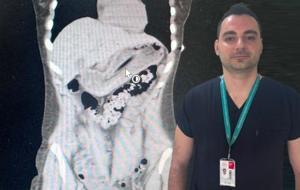 Zayıflamak İsterken Kabusu Yaşadı: Midesinden 13 Santimetrelik Diş Fırçası Çıktı... İşte Doktorları Şaşkına Çeviren Olay
