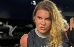 Acılı Süreci Gizlemedi! Biricik Suden Estetik Sonrası Görüntüsünü Paylaştı: “Sandığım Kadar Kolay Değilmiş”