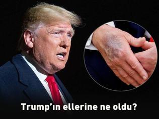 Dünya şokta Eline ne oldu Trump bizzat açıkladı