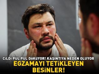 Egzamayı tetikliyor Cildi pul pul döküyor, kaşıntıya neden oluyor Bu besinlerden uzak durun