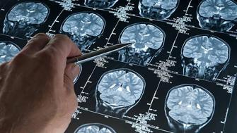 Her unutkanlık Alzheimer değil Özellikle bu belirtilere dikkat