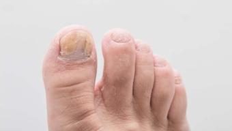 Şeker hastalığı tırnakları etkiliyor