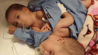 Siyam ikizleri iyileşti taburcu oluyor