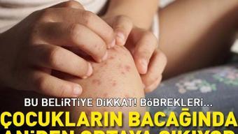 Çocuğunuzun bacağında aniden ortaya çıkan kızarıklığın sebebi bu olabilir İşte o hastalık: Böbreklerde kanamaya yol açabilir