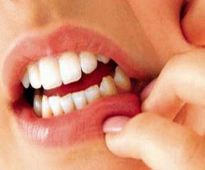 Diş eti çekilmesi nedir Nasıl tedavi edilir