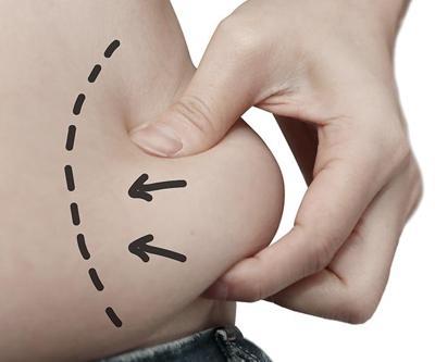 Liposuction nedir, en çok hangi bölgelere uygulanır