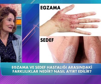 Egzama ve sedef hastalığı bulaşıcı mıdır