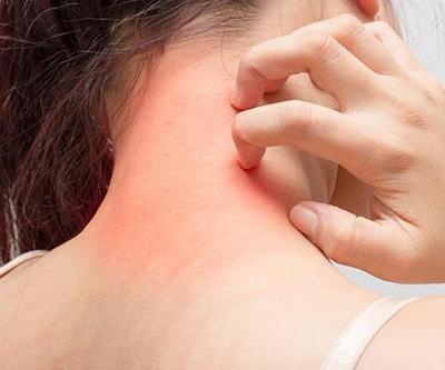 Uyuz Tedavisinde Sirke Kullanımı Nasıl Olur