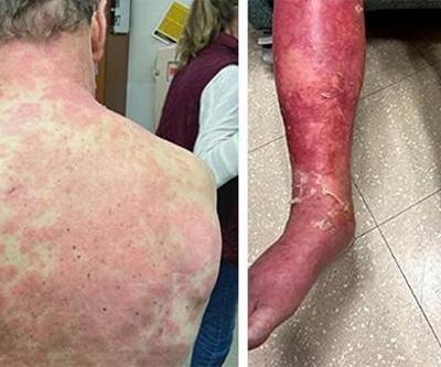 ABDde Johnson&Johnson aşını vurulan kişide yan etki kabusu