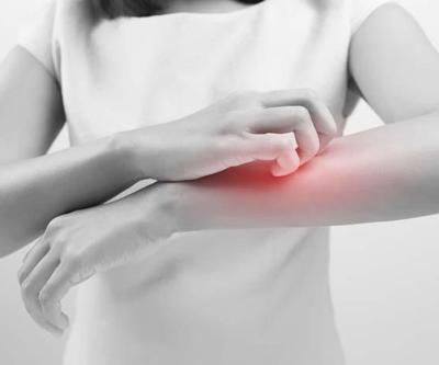 Arı alerjisi nedir, arı alerjisi belirtileri nelerdir