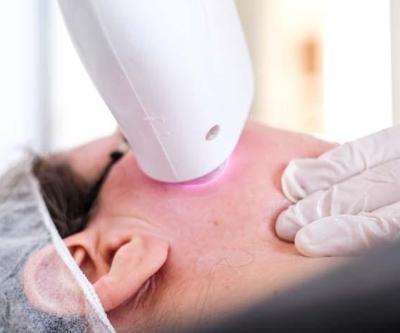 Lazer epilasyon nedir nelere dikkat edilmeli