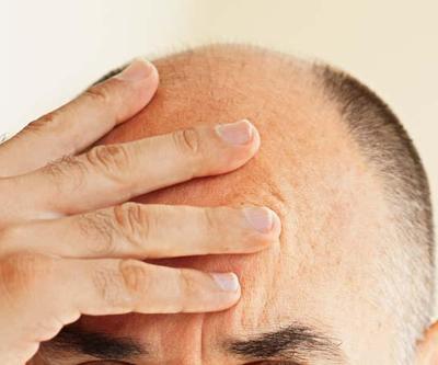 Saç Dökülmesi Tedavisinde Kullanılan İlaç, İntihar Düşüncesi Riskiyle İlişkilendirildi