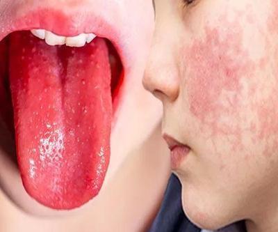 Strep A kabusu sürerken... Kızıl endişesi başladı: Türkiye’de görülüyor mu