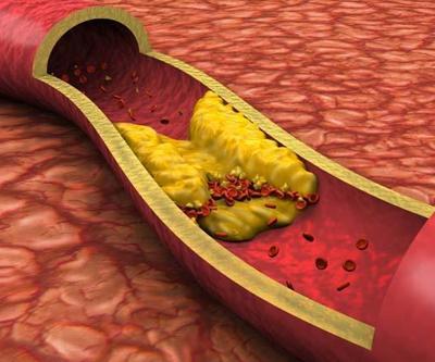 Damarlardaki plaklar nasıl önlenir Kolesterol ilaçları ne zaman gerekli Ne işe yarıyor