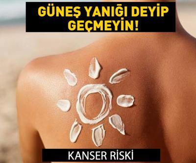 Güneş yanığı deyip geçmeyin Kanseri riski... Güneş yanığına ne iyi gelir