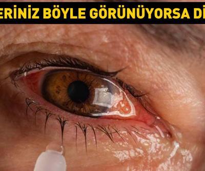 Gözleriniz böyle görünüyorsa dikkat Çiğ etten bile bulaşabiliyor 3 kritik belirti ile başlıyor... Tedavi edilmezse görme kaybına yol açıyor