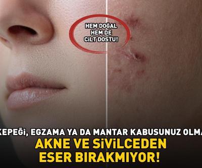 AKNE VE SİVİLCEDEN ESER BIRAKMIYOR Kilosu 700, 1 tanesi 50 TL Cilt dostu: Saç kepeği, egzama ile mantar kabusunuz olmasın