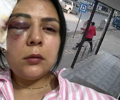Yolda Yürürken Yumruklu Saldırıya Uğramıştı Genç Kadın Konuştu