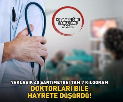 YAKLAŞIK 40 SANTİMETRE, TAM 7 KİLOGRAM Doktorları bile hayrete düşürdü Kilo aldığını sanıyordu, gerçek çok farklı çıktı