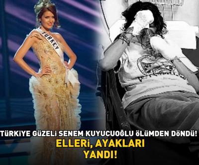 Türkiye Güzeli Senem Kuyucuoğlu ölümden döndü ELLERİ, AYAKLARI YANDI