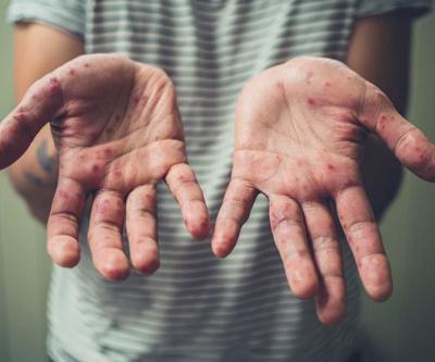 Çocuklarda el, ayak, ağız hastalığına dikkat Uzman isim belirtilerini anlattı