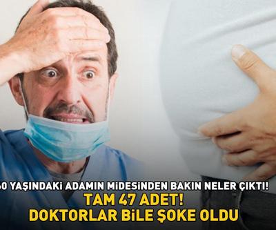 TAM 47 ADET 60 yaşındaki adamın midesinden bakın neler çıktı Doktorlar bile şaştı kaldı