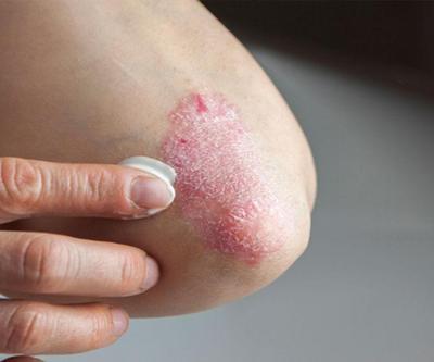 Sedef Hastalığı (Psoriasis) Nedir, Neden Olur Belirtileri ve Tedavi Yöntemleri Nelerdir