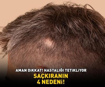 Aman dikkat Hastalığı tetikliyor SAÇKIRANIN 4 NEDENİ
