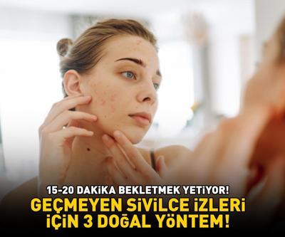 GEÇMEYEN SİVİLCE İZLERİ İÇİN 3 DOĞAL YÖNTEM Cildi bebek gibi yapıyor 15-20 dakika bekletmek yetiyor