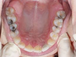 Diş çürükleri kanser habercisi olabilir
