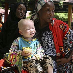 Burundide yine albino öldürüldü