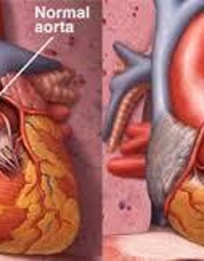 Aort kapak hastalığı nedir Nasıl tedavi edilir