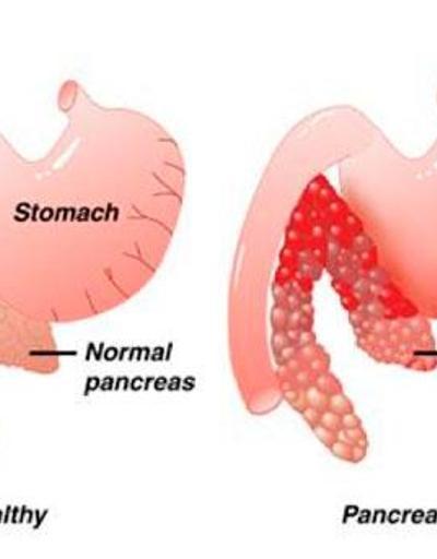 Pankreas iltihabı neden olur