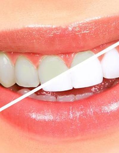 Diş beyazlatma nedir Yöntemleri nelerdir