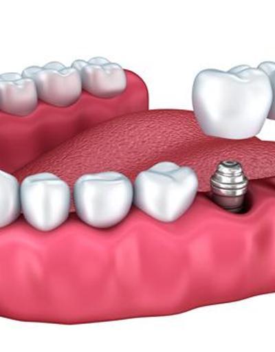 Diş implantları nasıl uygulanır